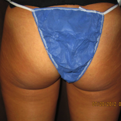 After, Apollo treatment for stretch marks